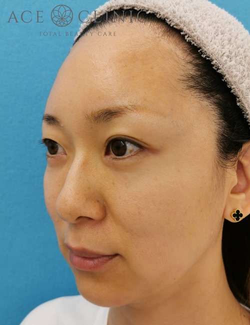 顔のリフトアップ・しわたるみ治療_ヒアルロン酸注入・ボトックス注射症例_【エースクリニック】名古屋院・大阪梅田院