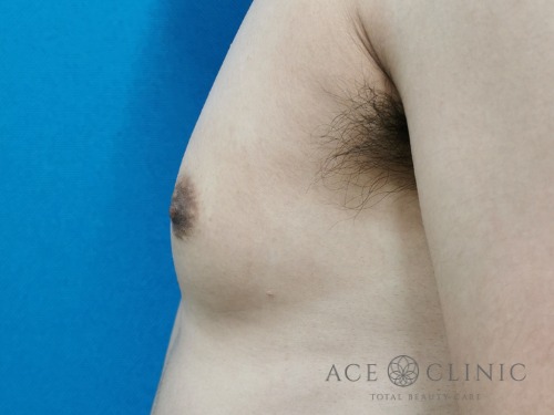 乳頭縮小_30代男性症例_【エースクリニック】名古屋院・大阪梅田院