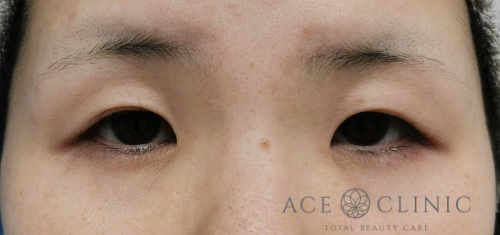 瞼のたるみ・眼瞼下垂治療_挙筋前転法症例【エースクリニック】名古屋院・大阪梅田院