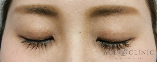 二重治療_プレミアム埋没法症例【エースクリニック】名古屋院・大阪梅田院) (1)