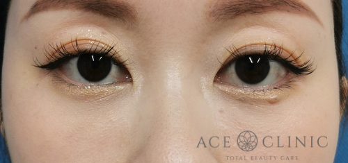 クマ・目元のたるみ治療_脱脂CRF法症例【エースクリニック】名古屋院・大阪梅田院のコピー (1)