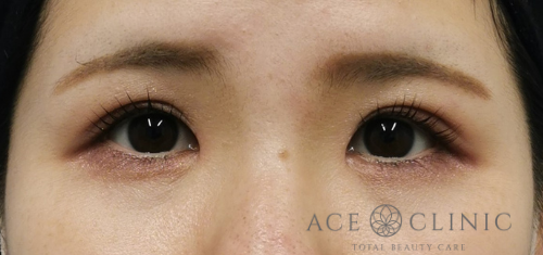 瞼のたるみ・眼瞼下垂治療_挙筋前転法症例【エースクリニック】名古屋院・大阪梅田院