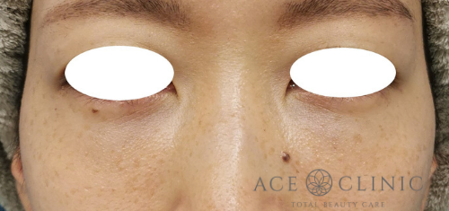 クマ・目元のたるみ治療_脱脂CRF法症例【エースクリニック】名古屋院・大阪梅田院