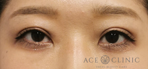 瞼のたるみ・眼瞼下垂治療_挙筋前転法症例【エースクリニック】名古屋院・大阪梅田院