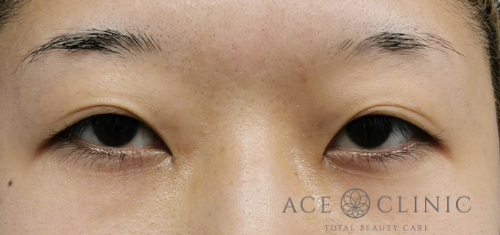 瞼のたるみ・眼瞼下垂治療_挙筋前転法症例【エースクリニック】名古屋院・大阪梅田院