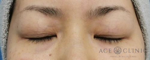 二重治療_プレミアム埋没法症例【エースクリニック】名古屋院・大阪梅田院