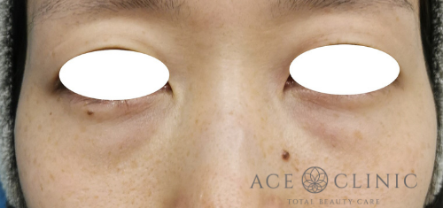 クマ・目元のたるみ治療_脱脂CRF法症例【エースクリニック】名古屋院・大阪梅田院