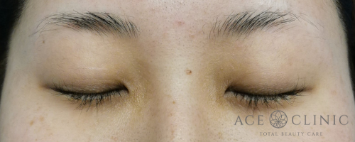 二重治療_プレミアム埋没法症例【エースクリニック】名古屋院・大阪梅田院