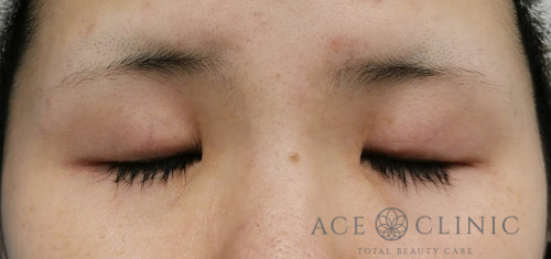 瞼のたるみ・眼瞼下垂治療_挙筋前転法症例【エースクリニック】名古屋院・大阪梅田院