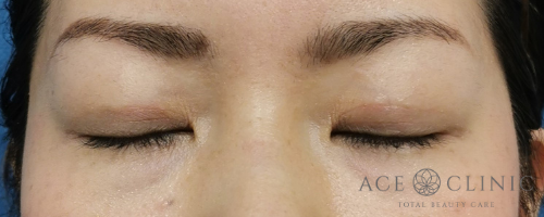 二重治療_プレミアム埋没法症例【エースクリニック】名古屋院・大阪梅田院