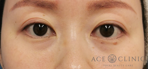 クマ・目元のたるみ治療_脱脂CRF法症例【エースクリニック】名古屋院・大阪梅田院のコピー