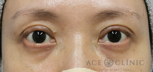 瞼のたるみ・眼瞼下垂治療_挙筋前転法症例【エースクリニック】名古屋院・大阪梅田院