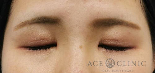 瞼のたるみ・眼瞼下垂治療_挙筋前転法症例【エースクリニック】名古屋院・大阪梅田院