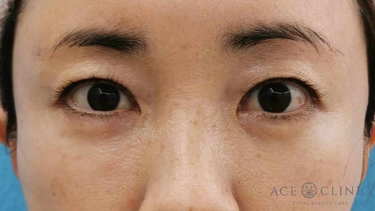 脱脂CRF法 術後 正面