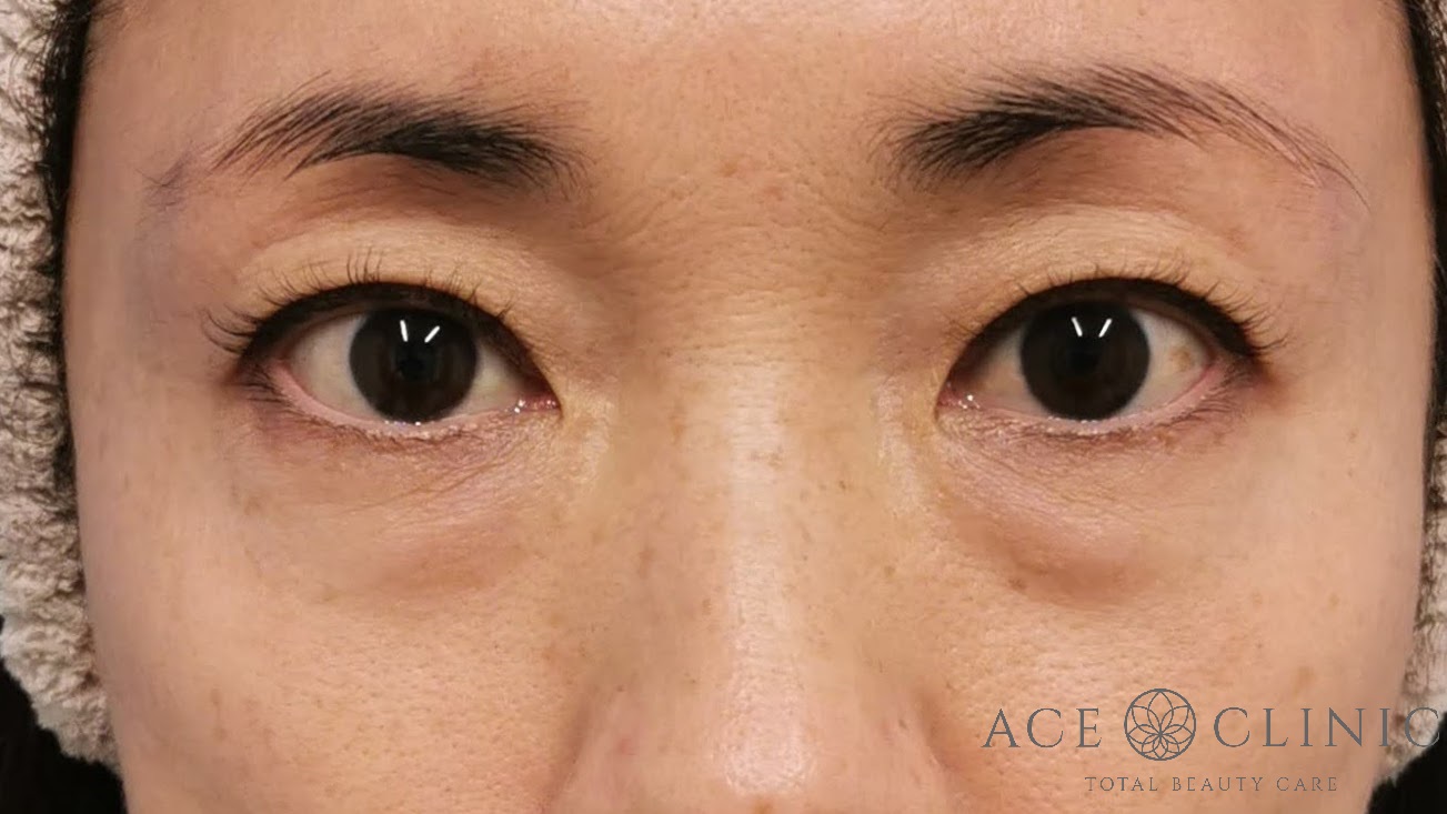 脱脂CRF法 術前 正面