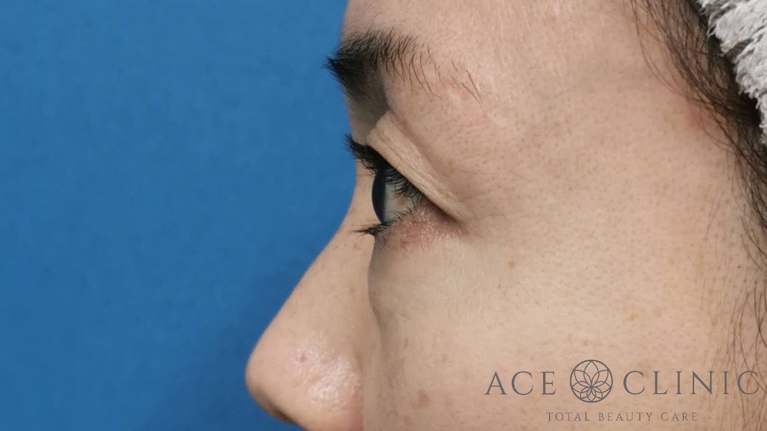 脱脂CRF法　術前　横