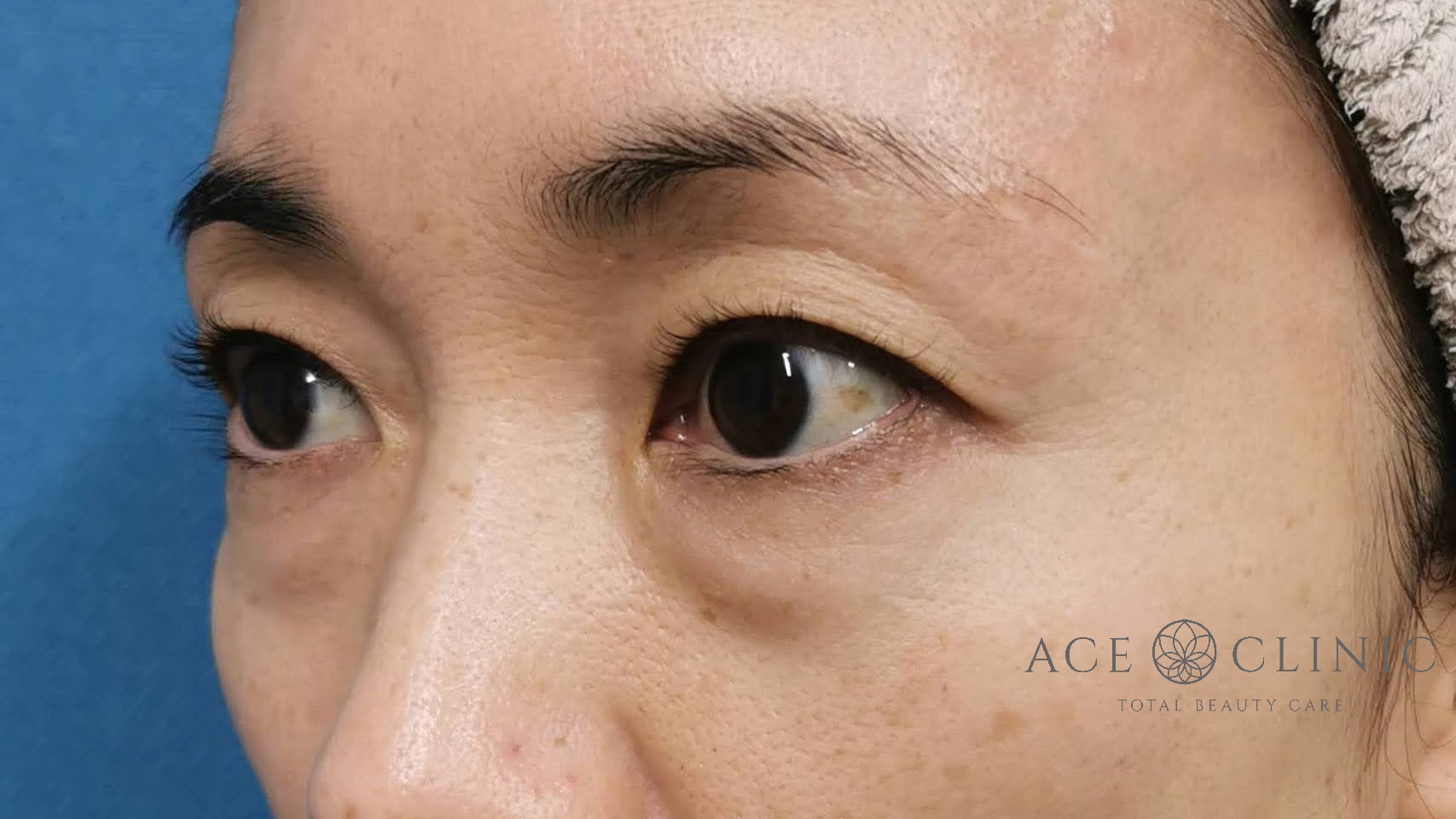 脱脂CRF法　術前　左斜位