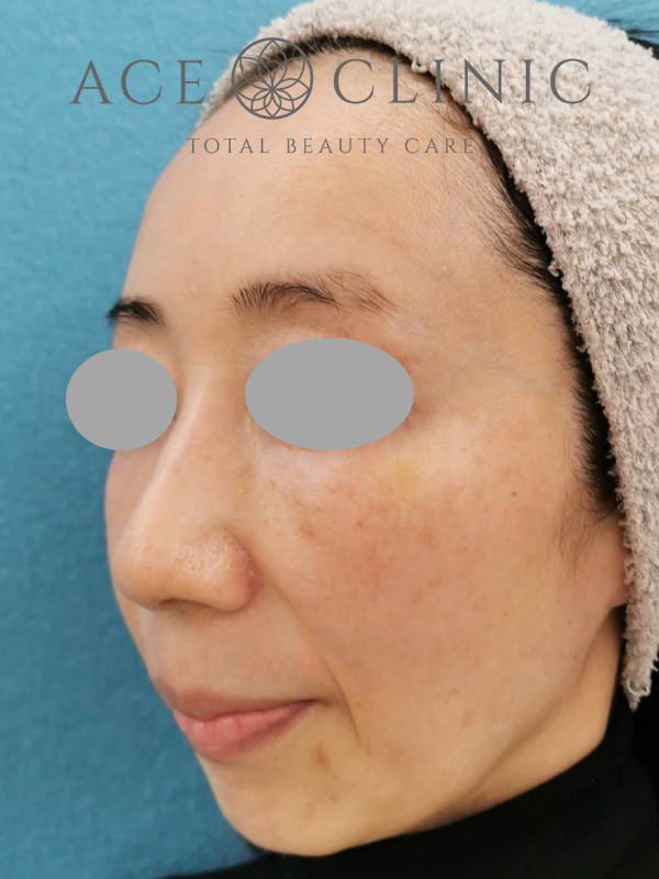 CRF脂肪注入(額・こめかみ・頬)|45歳女性|症例4|術後|左斜め|大阪梅田【エースクリニック】