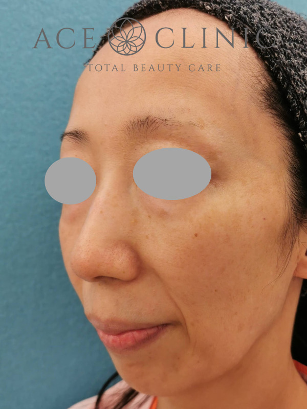 CRF脂肪注入(額・こめかみ・頬)|45歳女性|症例4|術前|左斜め|大阪梅田【エースクリニック】