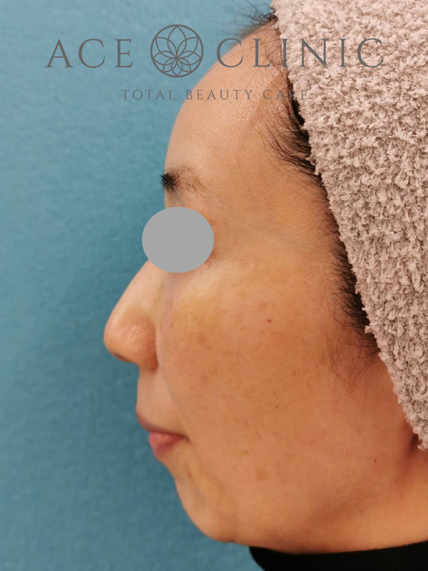 CRF脂肪注入(額・こめかみ・頬)|45歳女性|症例4|術後|左横|大阪梅田【エースクリニック】