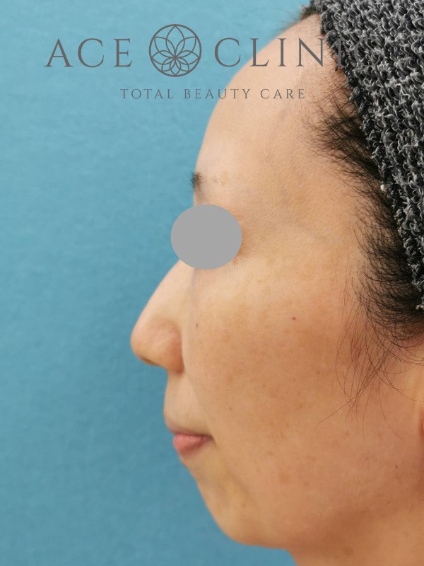 CRF脂肪注入(額・こめかみ・頬)|45歳女性|症例4|術前|左横|大阪梅田【エースクリニック】