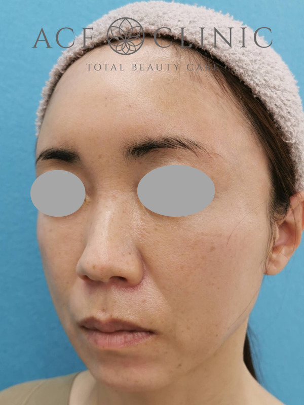 CRF脂肪注入（額・こめかみ・頬）｜47歳女性｜症例5｜術後｜左斜め｜大阪梅田【エースクリニック】