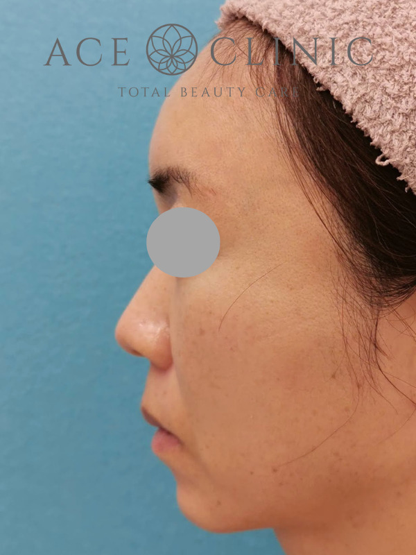 CRF脂肪注入（額・こめかみ・頬）｜47歳女性｜症例5｜術後｜左横｜大阪梅田【エースクリニック】