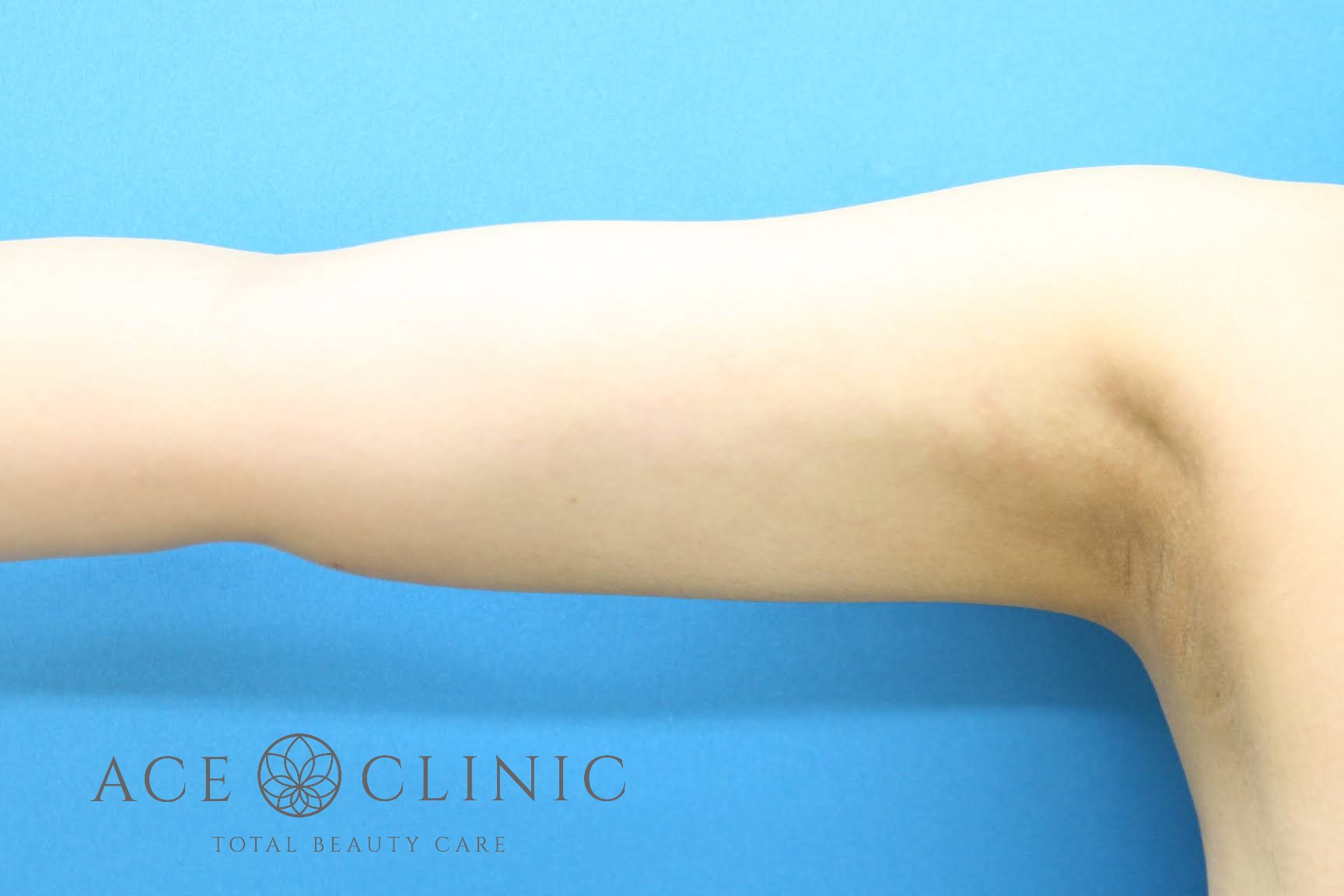 上腕脂肪吸引 右 前 術後