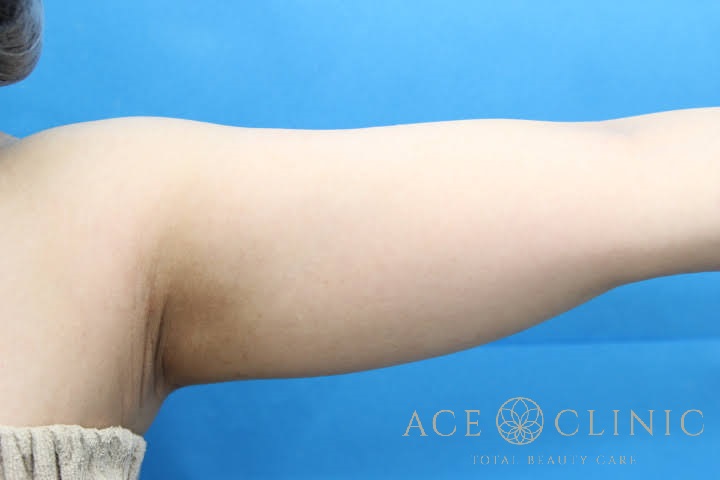 上腕脂肪吸引 左前 術前