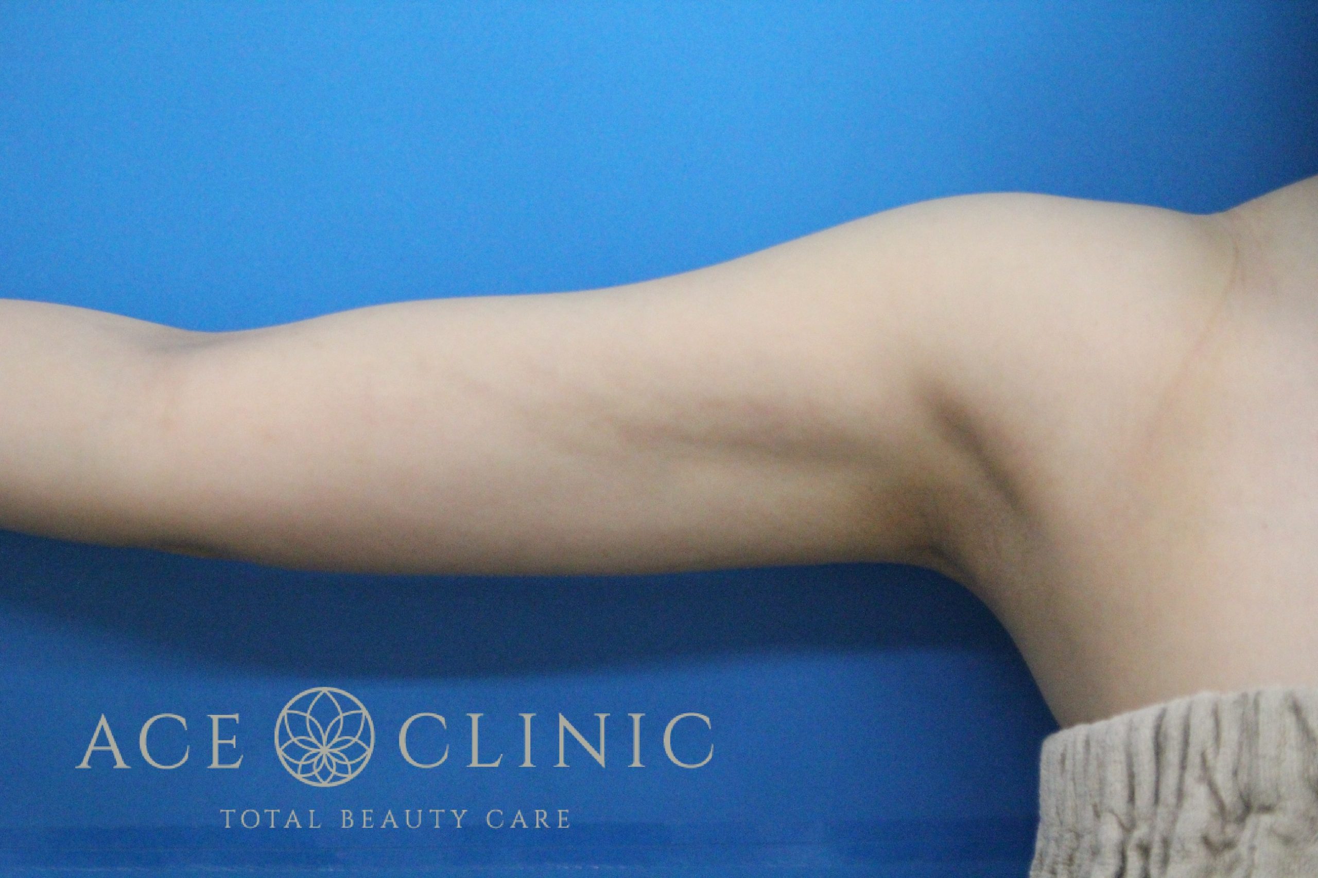 上腕脂肪吸引　右　術後