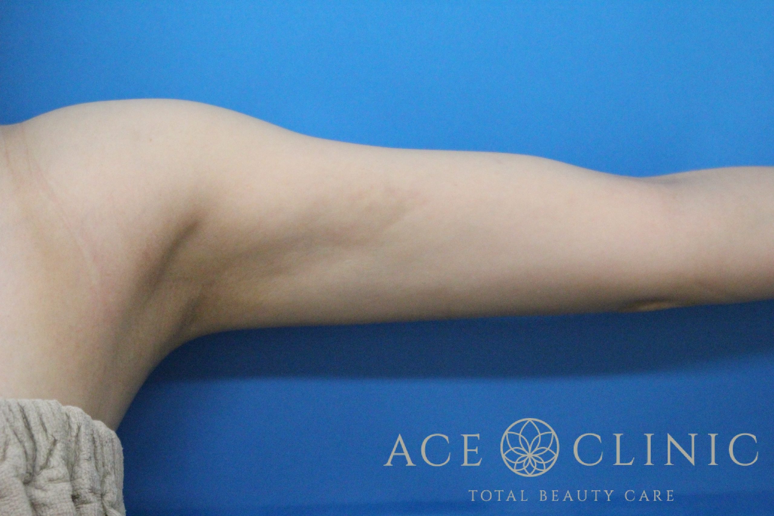 上腕脂肪吸引 左 術後