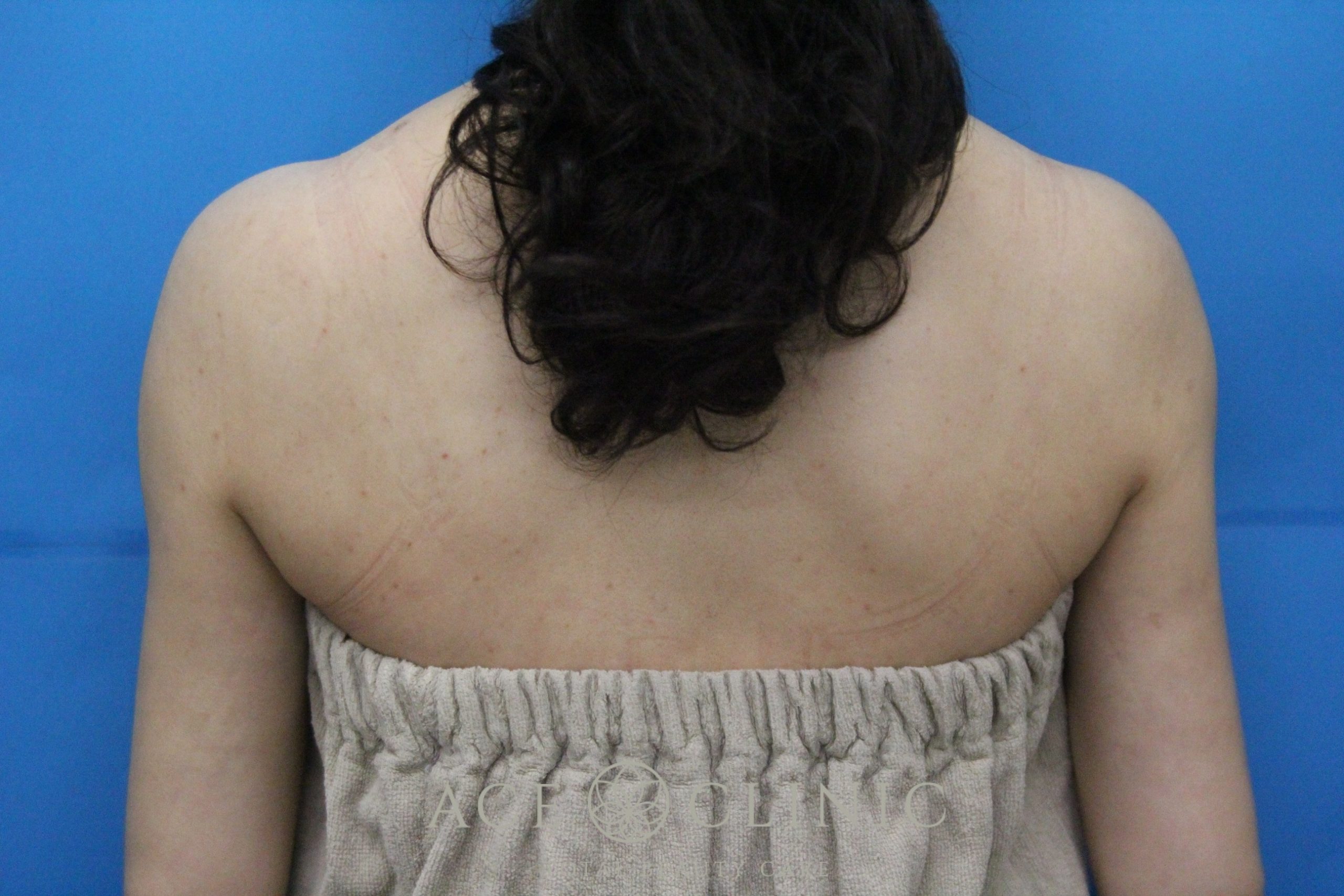 上腕脂肪吸引 後ろ 術後