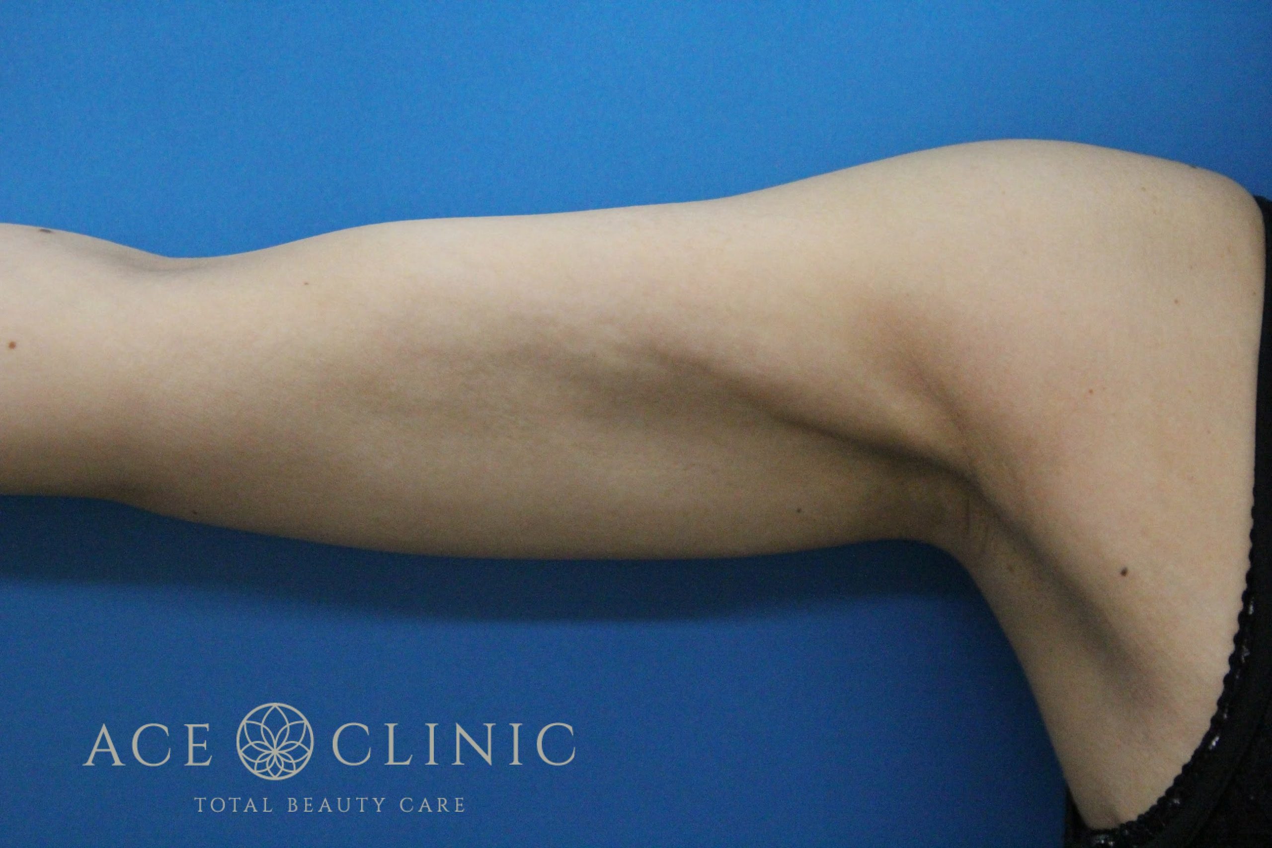 上腕脂肪吸引　右　術後