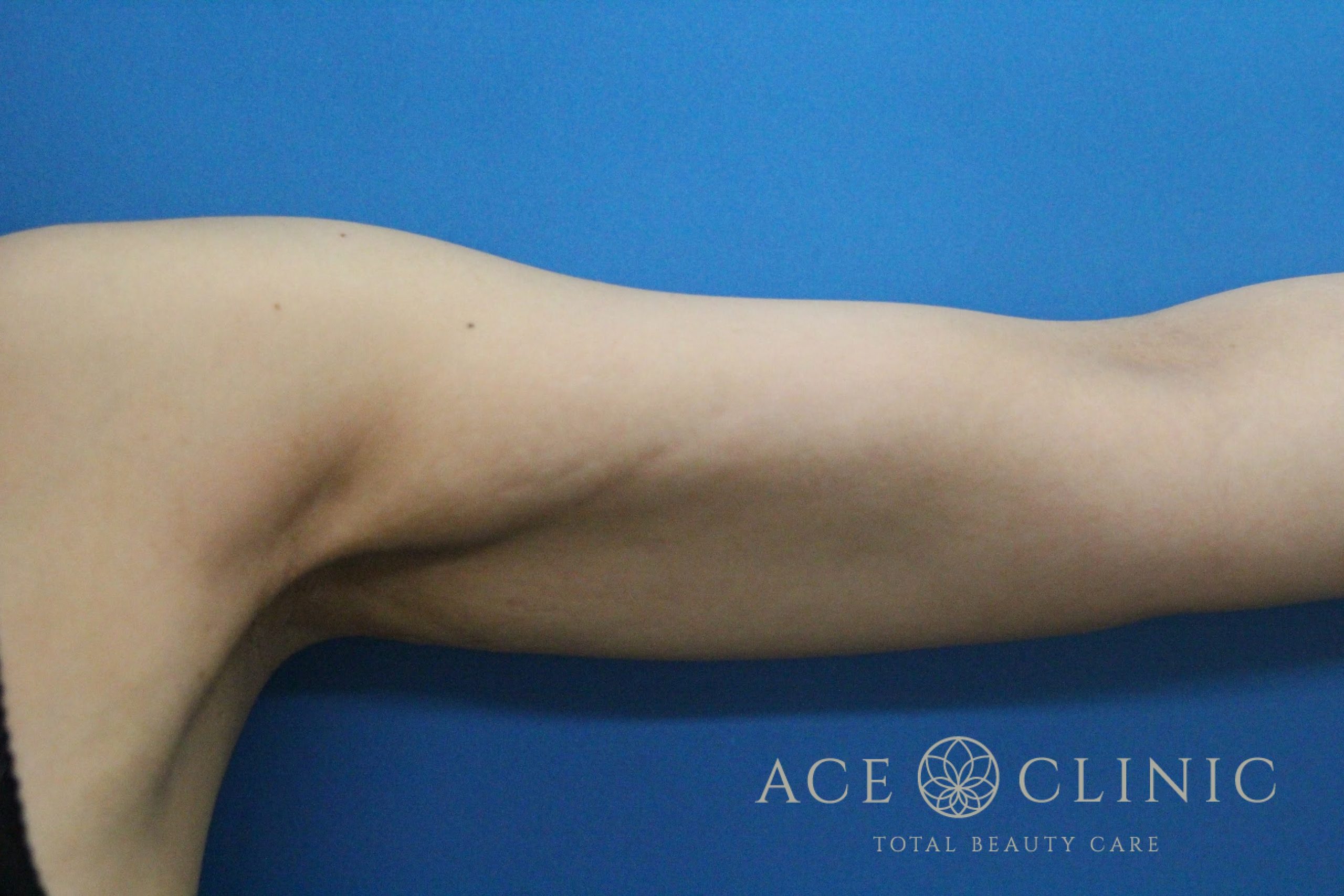 上腕脂肪吸引　左　術後