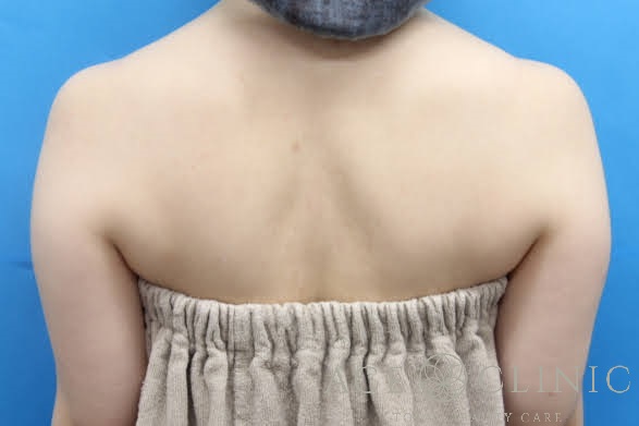 上腕脂肪吸引　後ろ　術前