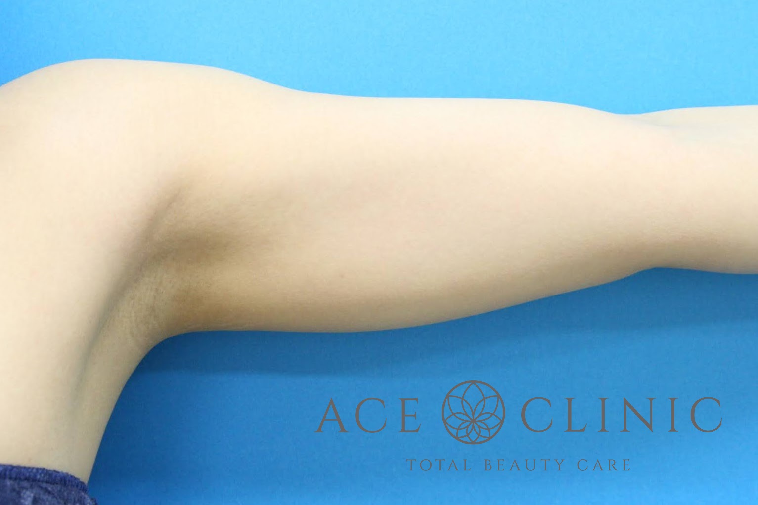 上腕脂肪吸引 左 術前