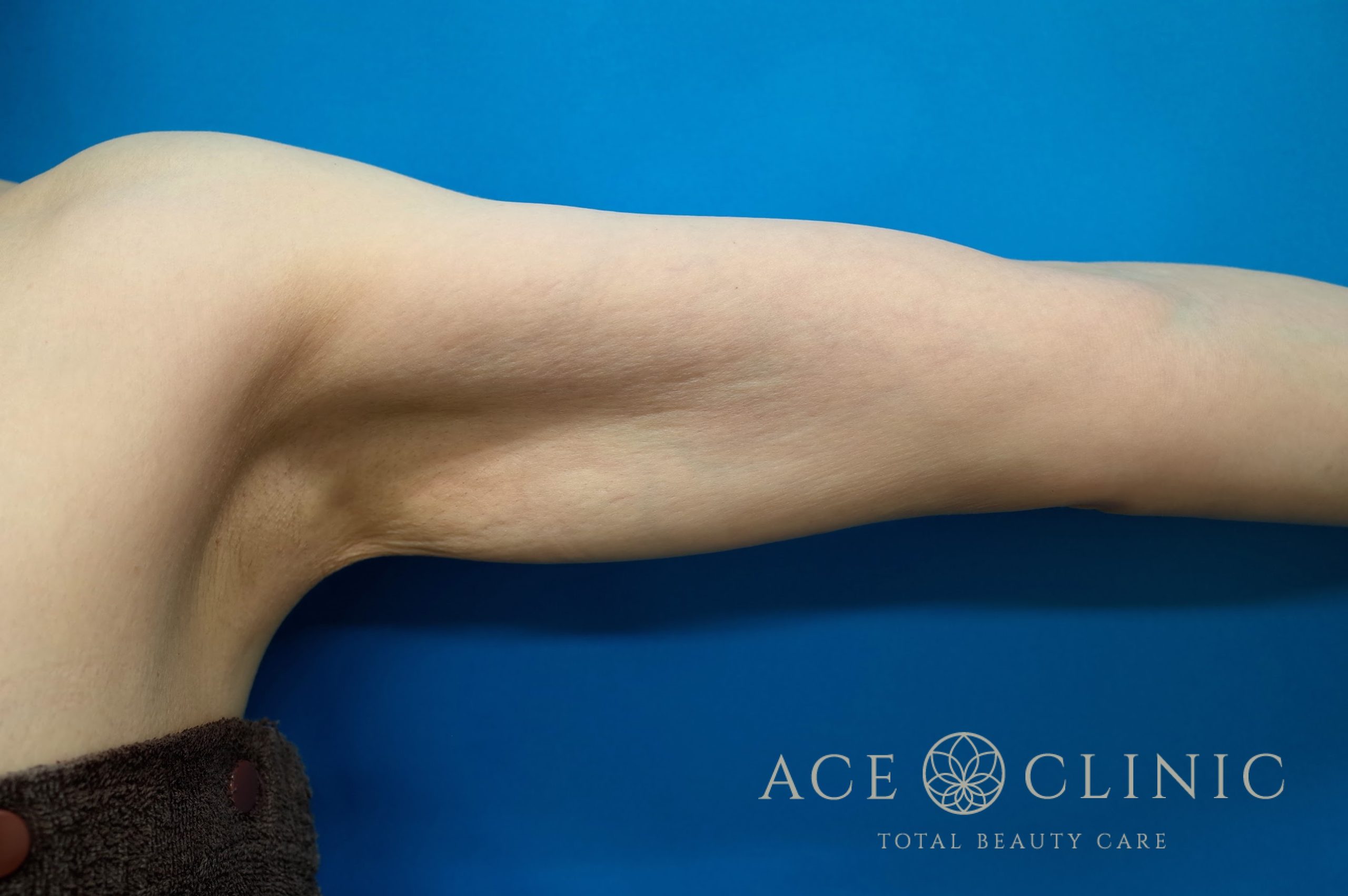 上腕脂肪吸引 左 術後