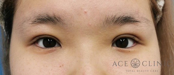 眼瞼挙筋前転法‗眼瞼下垂治療【エースクリニック】名古屋院・大阪梅田院 (9)