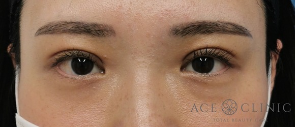 眼瞼挙筋前転法‗眼瞼下垂治療【エースクリニック】名古屋院・大阪梅田院 (3)