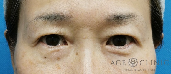 眉毛下切開法‗目元のたるみ治療【エースクリニック】名古屋院・大阪梅田院 (6)