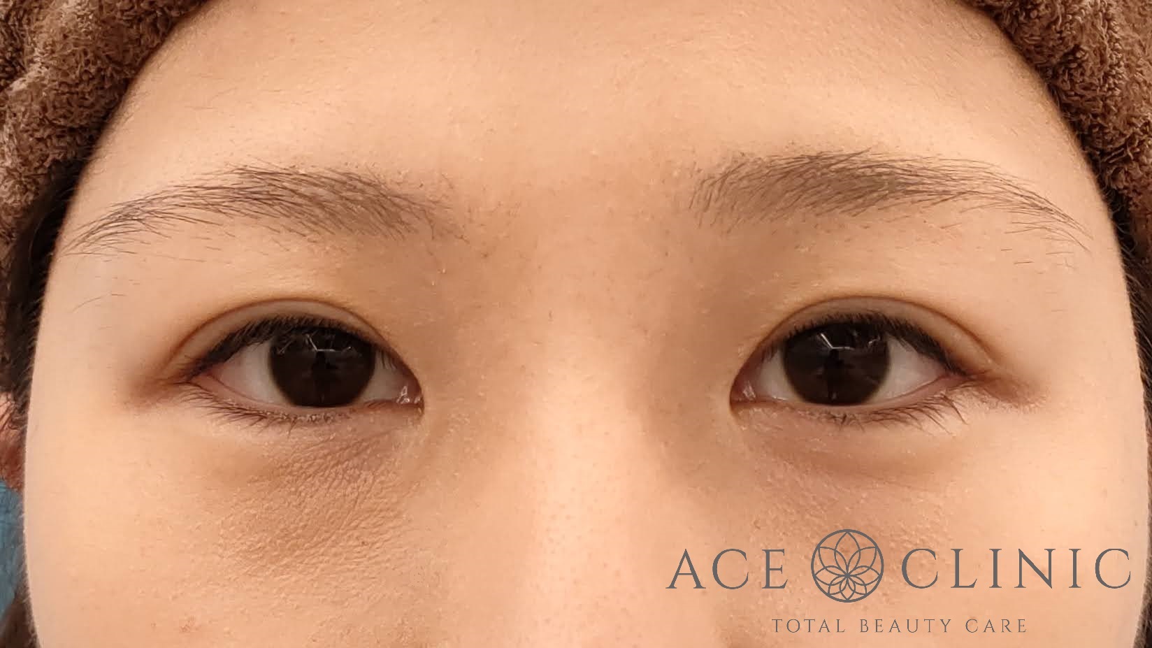 眼瞼挙筋前転法 20代女性 術1年後 名古屋【エースクリニック】