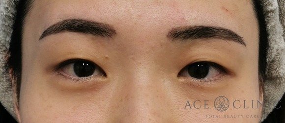 眼瞼挙筋前転法‗眼瞼下垂治療【エースクリニック】名古屋院・大阪梅田院 (2)