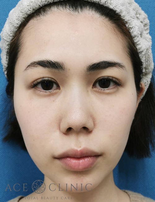 脱脂CRF法‗目の下のクマ治療【エースクリニック】名古屋院・大阪梅田院 (1)