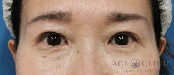 眉毛下切開法‗目元のたるみ治療【エースクリニック】名古屋院・大阪梅田院