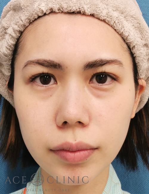 脱脂CRF法‗目の下のクマ治療【エースクリニック】名古屋院・大阪梅田院