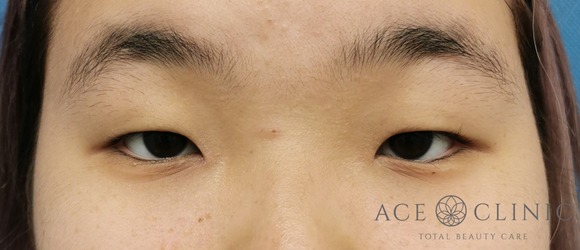 眼瞼挙筋前転法‗眼瞼下垂治療【エースクリニック】名古屋院・大阪梅田院 (8)