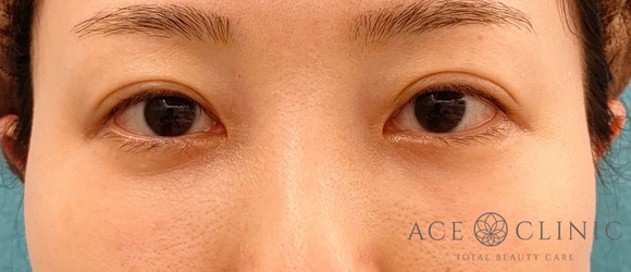 継結膜ハムラ法‗目元のクマ治療【エースクリニック】名古屋院・大阪梅田院