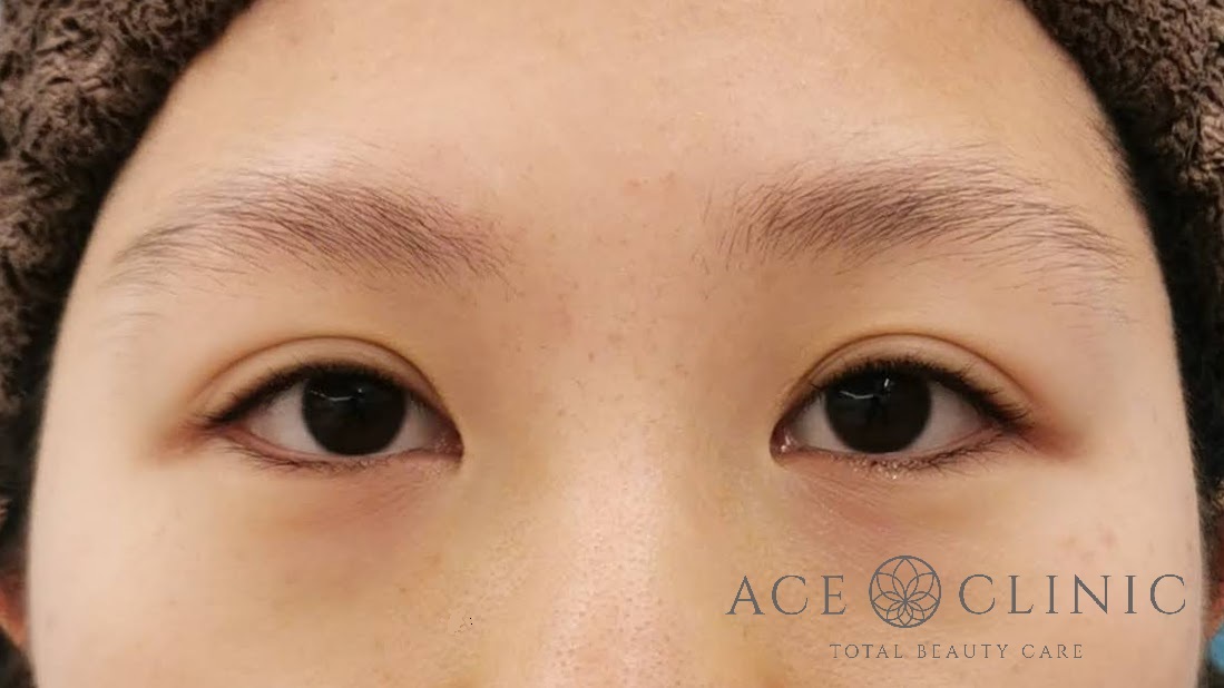 眼瞼挙筋前転法 20代女性 術前 名古屋【エースクリニック】