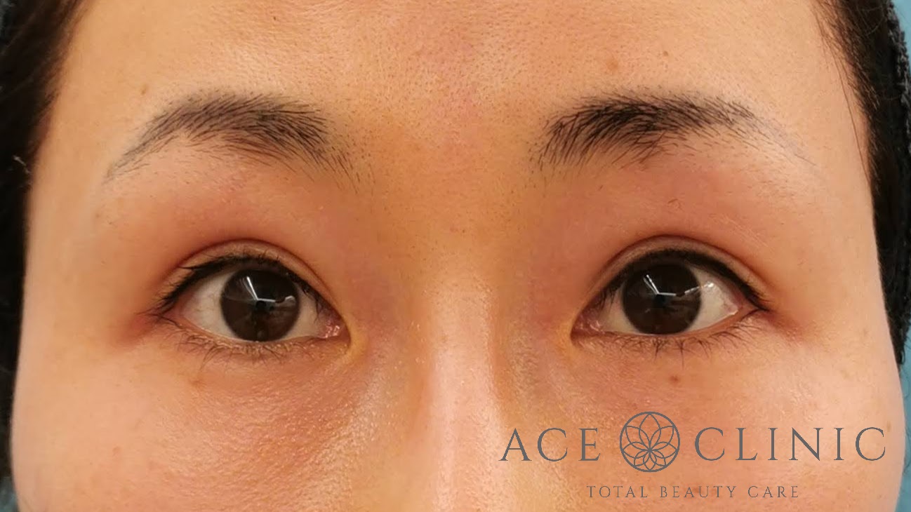 眼瞼挙筋前転法 30代女性 術1ヶ月後 名古屋【エースクリニック】
