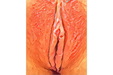 小陰唇縮小術　症例　術後｜大阪梅田【エースクリニック】